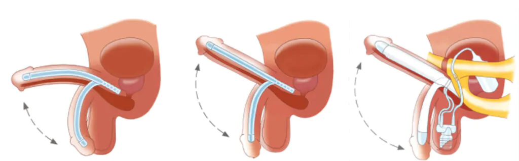 Prótese Peniana 1 andrologista em santos
